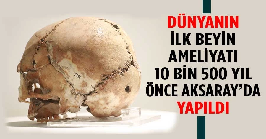 Dünyanın ilk beyin ameliyatı 10 bin 500 yıl önce Aksaray’da yapıldı   